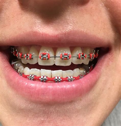 Pin by Gianellavv on braces | Braces teeth colors, Teeth braces, Cute ...