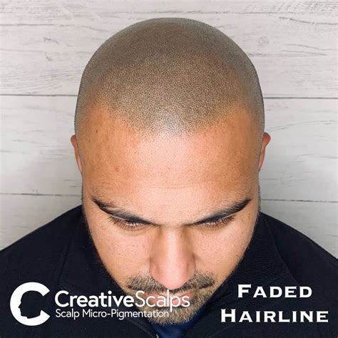 Scalp Micropigmentation Reviews | SMP Reviews | Creative Scalps