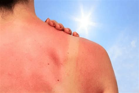 Everything you need to know about sunburn itching | Vinmec