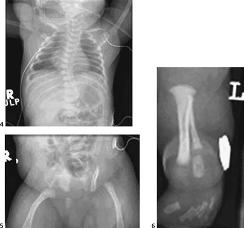 123 Campomelic Dysplasia | Radiology Key