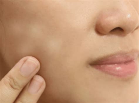 White spots on kid’s face: causes and remedies - Iyurved