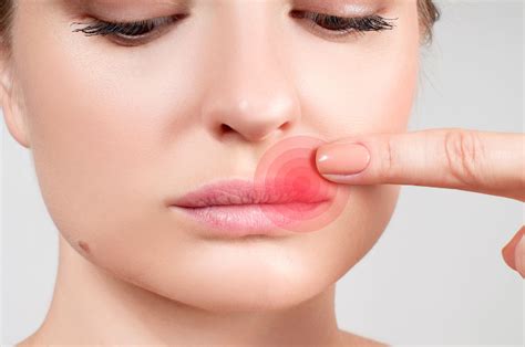 Herpes Lesions On Lips | Lipstutorial.org