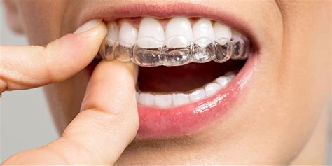 Best invisible aligners - gulflounge