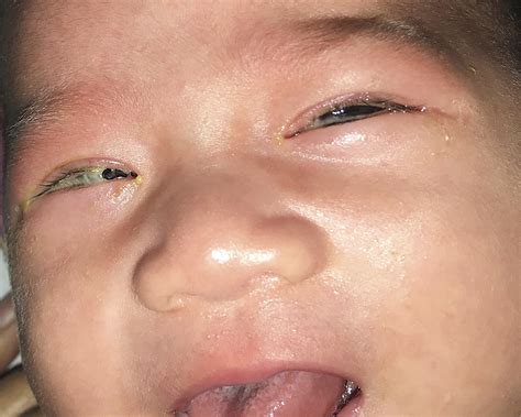 Neonatal Gonococcal Conjunctivitis