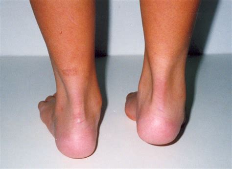 A 12 year-old female patient with Rt equinovarus hind foot deformity on ...