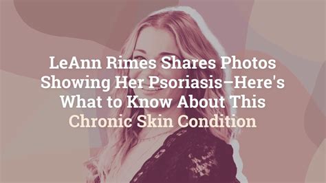 LeAnn Rimes Shares Photos Showing Her Psoriasis–Here's What to Know About This Chronic Ski