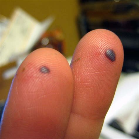 Top 93+ Pictures What Does An Infected Blood Blister Look Like Completed