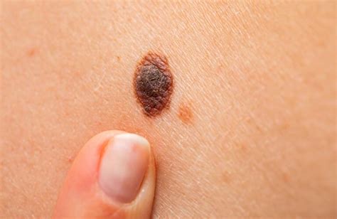 How to Identify Atypical Moles | Dysplastic Nevi & Benign Moles