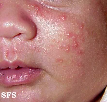 Neonatal acne - wikidoc