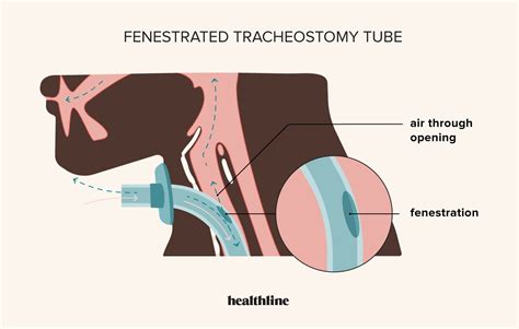 Fenestrated Tracheostomy Tube: Purpose, Uses, and Risks