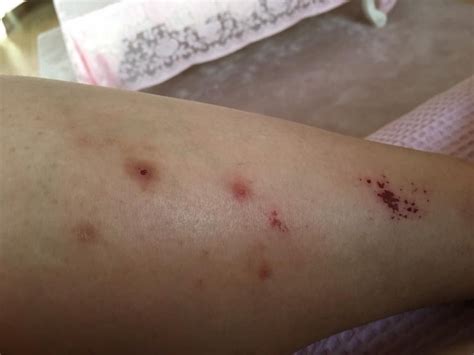 What is the Asian Tiger Mosquito, how can it be detected? Even a single bite hurts… – Kimdeyir