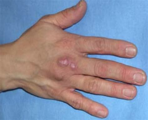 Atypical Mycobacterium Infections - Hand - Orthobullets