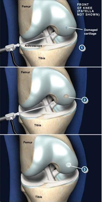 Arthroscopic Chondroplasty - Sarasota, FL: Schofield, Hand and Bright Orthopaedics