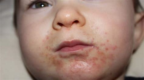 What is Strep Rash in Kids? | Health Digest