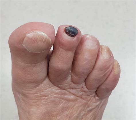 What Causes Thick Black Toenails - Nail Ftempo