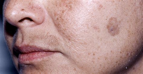 Aging Spots On Skin