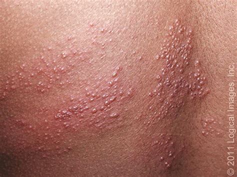 Shingles as related to Skin - Pictures