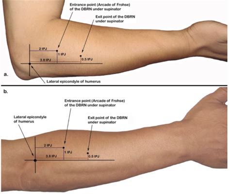 Posterior Interosseous Nerve: Injury to The Incarcerated forearm - Dr. Justin Dean