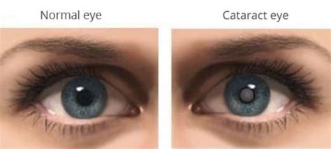 Cerulean Cataract - Atlas Eye