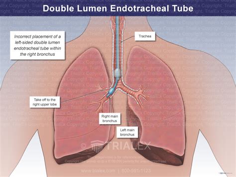 Double Lumen Endotracheal Tube Incorrectly Placed - TrialQuest In...