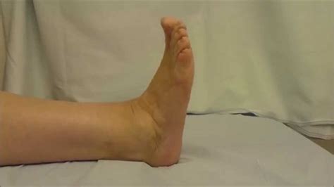 Movement After Ankle Fusion - YouTube