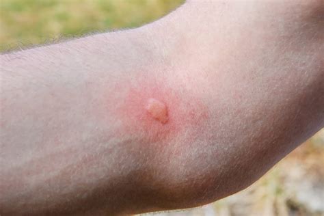 Why Do Mosquito Bites Itch? - Green Pest Services