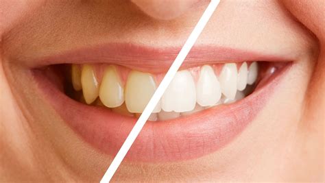 Deep Teeth Cleaning: Before and After - Dental Health Society