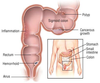 Sigmoidoscopy Guide | Drugs.com