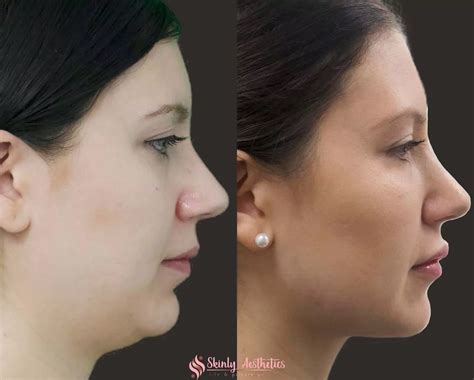 CoolSculpting For Double Chin Removal | Skinly Aesthetics