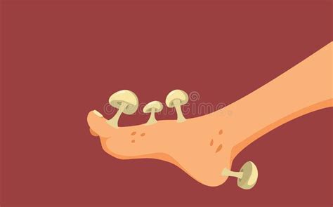 Foot with Fungus Problem Concept Cartoon Illustration Stock Vector - Illustration of bacterial ...