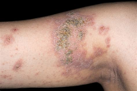 Prevalence of Atopic Dermatitis 7.3% in U.S. Adults - The Clinical Advisor