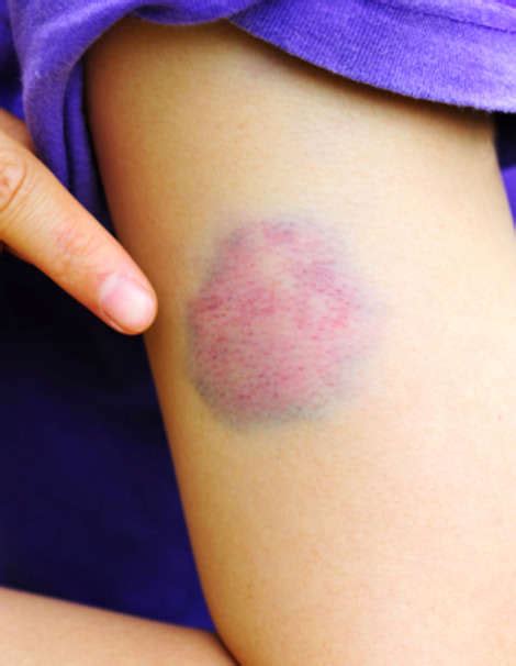 9 Weird Facts About Bruises