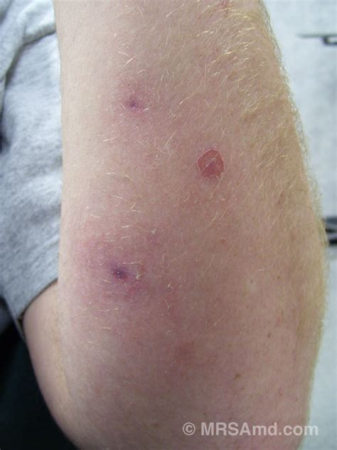 MRSA Pictures / Staph Infection Pictures/Graphic Images – MRSA MD