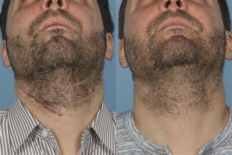 Before & After Pictures | Scar Revision Chicago, IL |Dr. Sidle