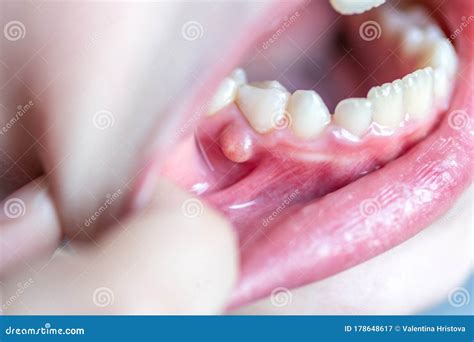 Close - Up On The Lip With Aphthous Stomatitis Applying Antibacterial ...