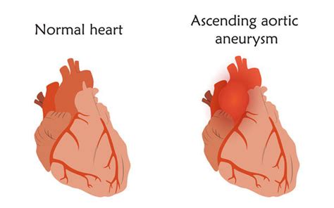 Aortic Valve Ascending Aorta