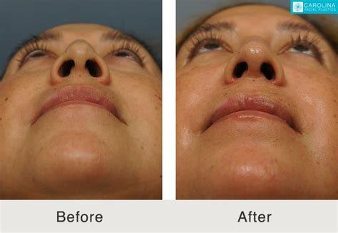 Latino Rhinoplasty to Remove Bump on Nasal Bridge - Carolina Facial Plastics