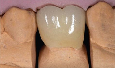 Ceramic crown after porcelain application | Download Scientific Diagram