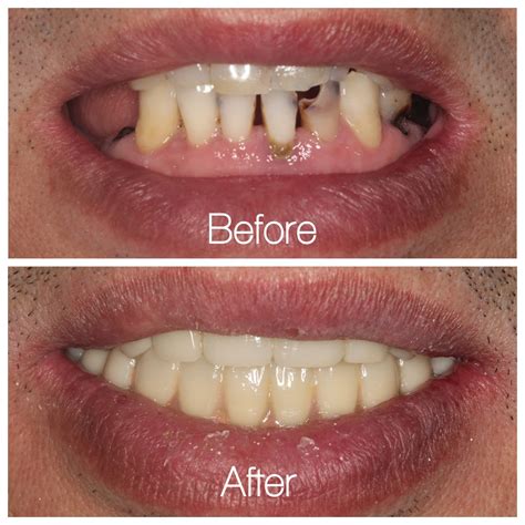 Dental Veneers Before And After : Injectable Veneers | fonewall