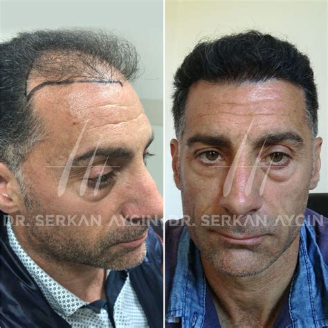 DHI Hair Transplant: 3150-3200 Grafts - Dr. Serkan Aygin Clinic