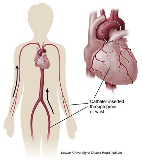 Catheter-Insertion points - Atrial Fibrillation: Resources for Patients