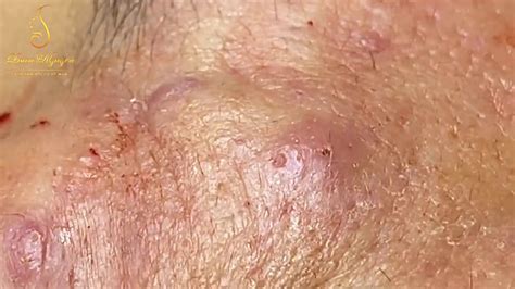 BLACKHEADS REMOVAL (286) | Loan Nguyen