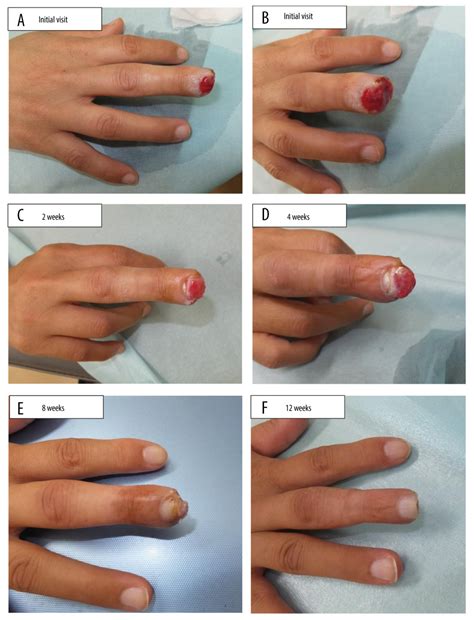 American Journal of Case Reports | Fingertip Amputation Injury of Allen ...