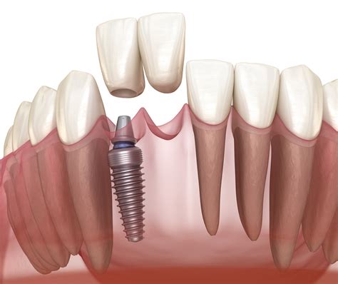 Cantilever Dental Bridge Pros And Cons at Gary Reames blog