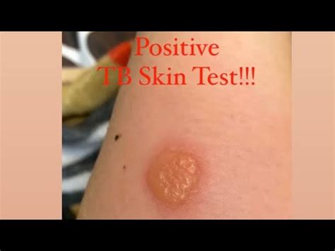 POSITIVE TB SKIN TEST!!! - YouTube