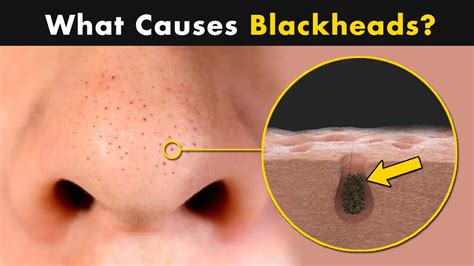 What Causes Blackheads on Our Skin? | Symptoms, Causes And Treatment ...