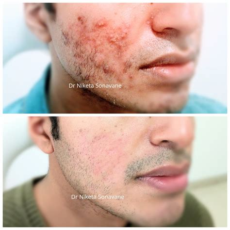 Acne Treatment In Mumbai - Cost, Before After, Laser, Acne Specialist