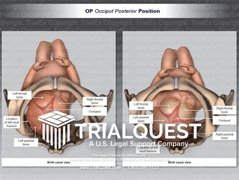 OP (Occiput Posterior) Position Birth Canal View - TrialExhibits Inc.