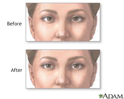 Eye muscle repair Information | Mount Sinai - New York