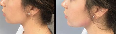 Chin Implant Treatment - Richmond and Midlothian, VA | Synergy Face + Body by Travis Shaw, MD